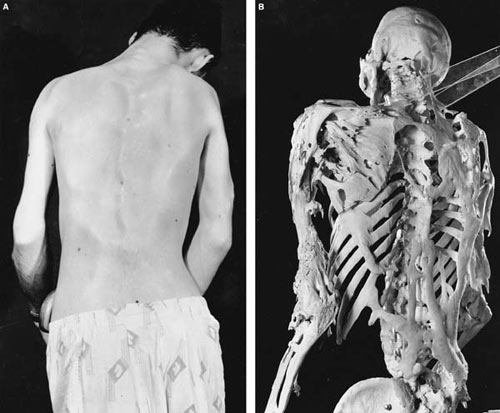 Harry Eastlack's skeleton
